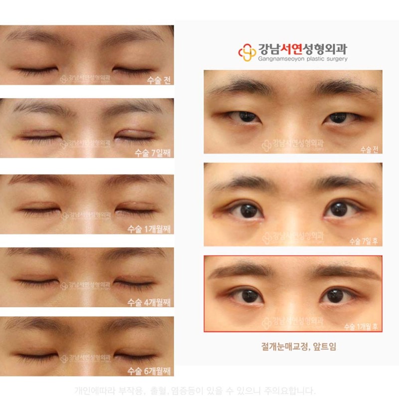 강남서연성형외과 최동일원장 [절개 눈매교정수술] : 네이버 블로그